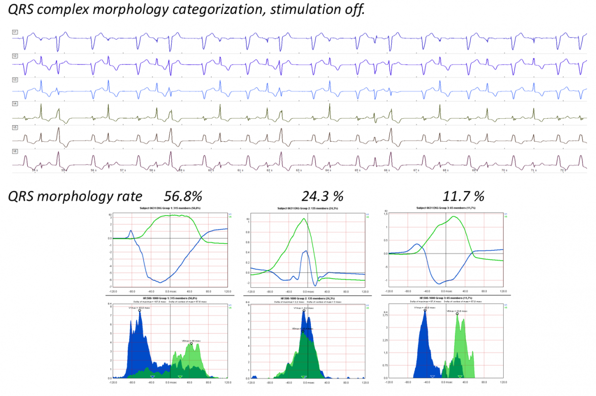 QRS