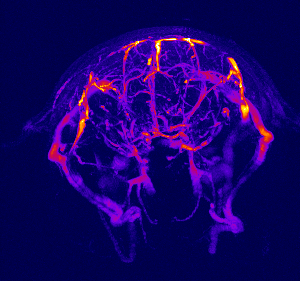Perfusion MRI